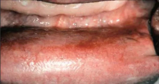 Figure 15 : Plages érythémateuses sur la muqueuse labiale inférieure chez un patient  carencé en vitamine B12 (95) 