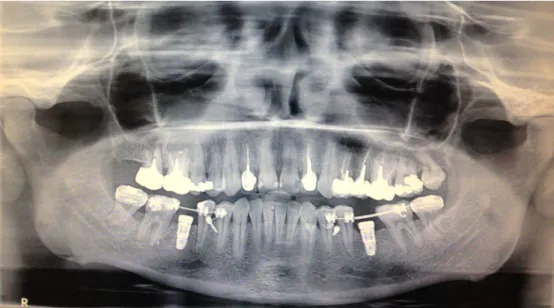Figure	 16	-	 Orthopantomogramme	 de	 contrôle	 de	 Mme	 B,	 avant	 pose	 de	 l’indication	 de	 l’endodontie	chirurgicale	