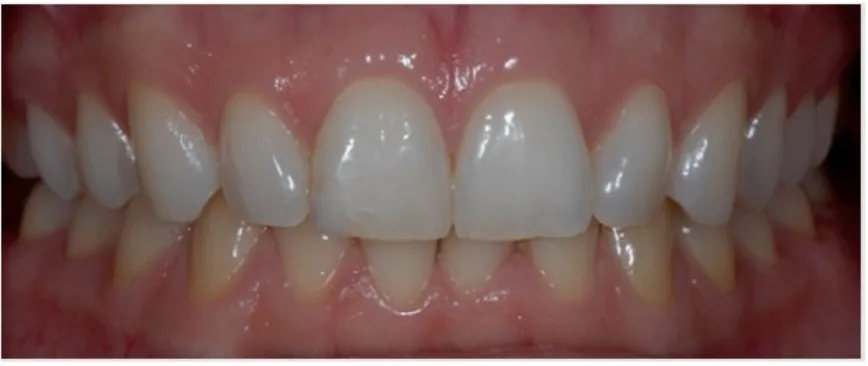 Figure	15:Une	gencive	saine	