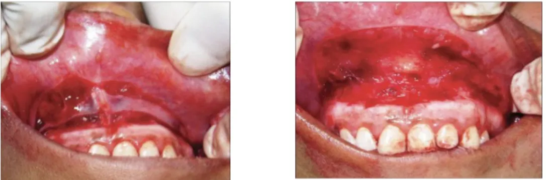 Figure	26	:	excision	de	la	bande	de	muqueuse	en	demi-épaisseur	