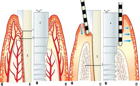 Figure 5: Schémas représentant les tissus parodontaux et la muqueuse péri-implantaire