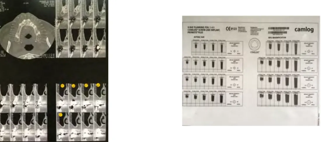 Figure 7 : Planche radiographique avec coupes coronales et calque d’implants. 
