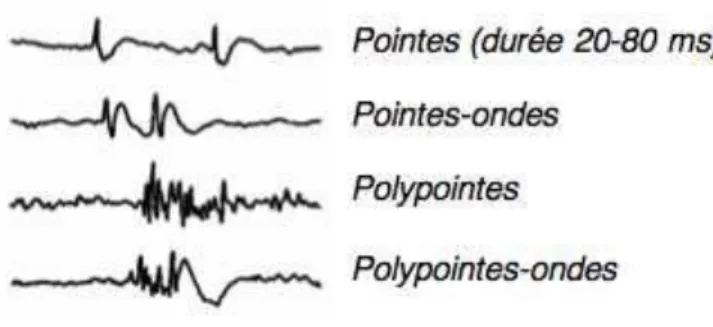 Figure 8 : Aspects de différents tracés de paroxysmes [42] 