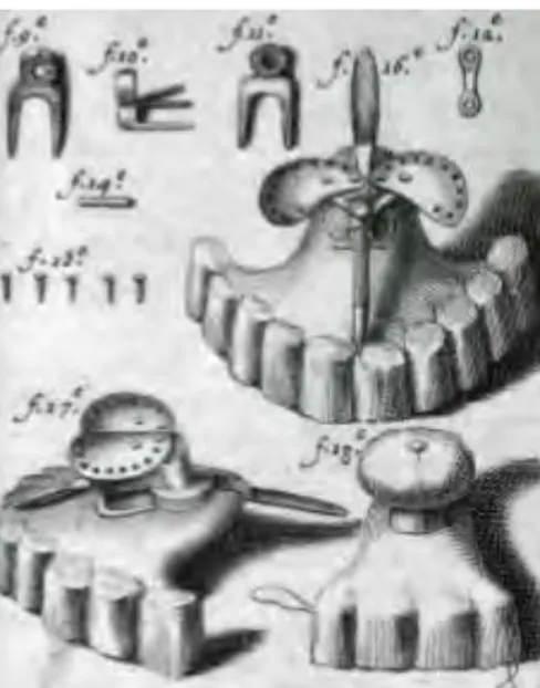 Figure 4 : iconographie de prothèses obturatrices conçues et réalisées par Pierre Fauchard