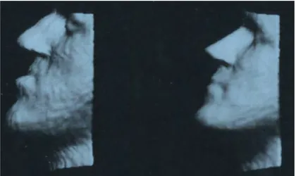 Figure 13 : image 3D du profil avant et après chirurgie obtenue avec un scanner de surface