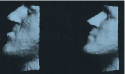 Figure 13 : image 3D du profil avant et après chirurgie obtenue avec un scanner de surface