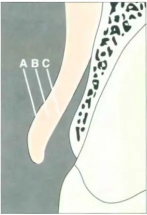 Figure 4:Lambeau pleine épaisseur incluant la muqueuse (A), le tissu  conjonctif (B) et le périoste (C) (15) 