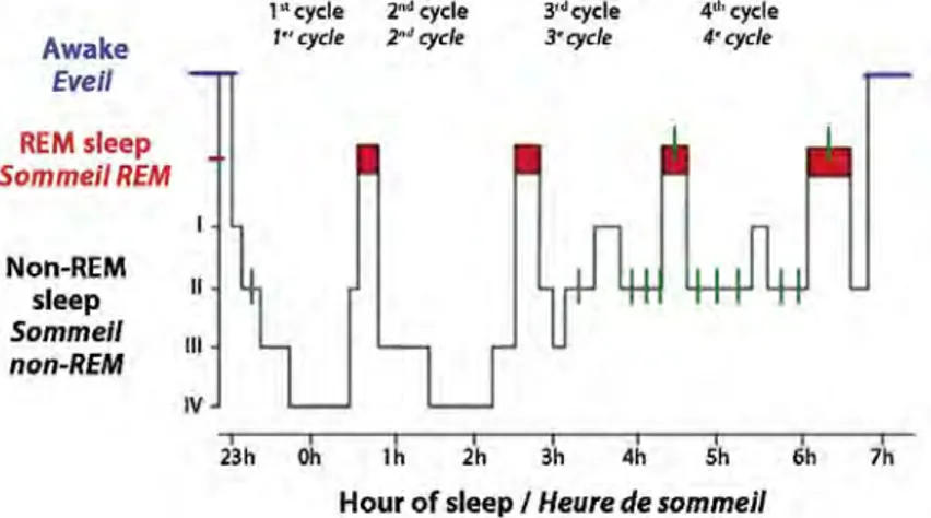 Figure n°2 : Hypnogramme. Les épisodes de bruxisme (en vert) apparaissent classiquement  dans le stade II du sommeil non-rem