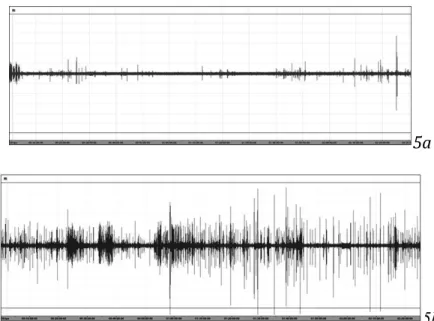 Figure n°5 : Electromyographie des muscles masticateurs.5a : Absence de bruxisme de  l’éveil