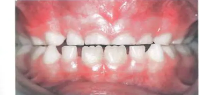 Figure n°7 : Diagnostic de bruxisme chez un enfant de 7 ans. 
