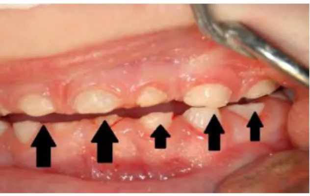 Figure n°9 : Bruxisme et perturbation de l’occlusion chez l’enfant. 