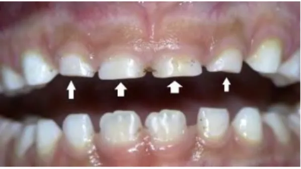 Figure n°11 : Usure des dents antérieurs. 