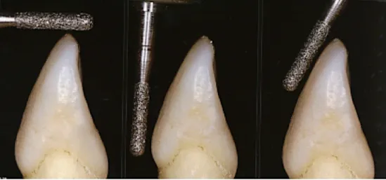 Figure 3 : Photographies des différentes angulations de la fraise lors de la préparation (21) 