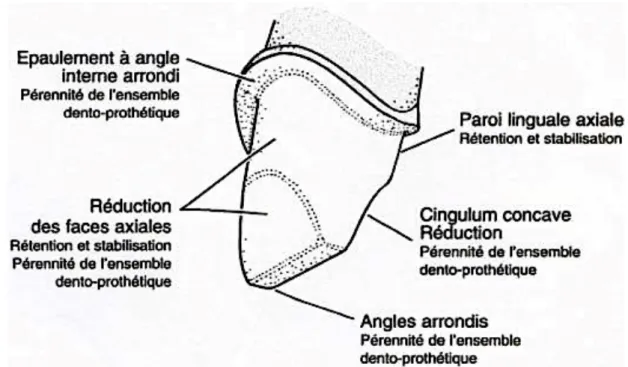 Figure 6 : Schéma de la préparation achevée d’une incisive centrale pour couronne céramo- céramo-céramique (13) 