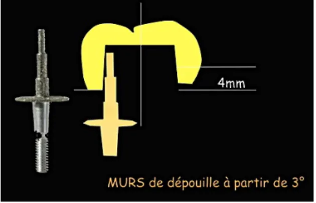 Figure 17 : Schéma illustrant l’influence de la conicité de la fraise du système CEREC sur  l’angulation des parois (44) 
