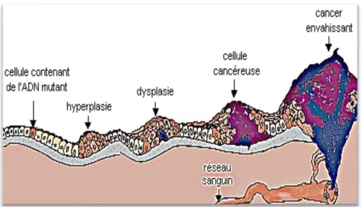 Figure 2: Evolution de la cancérogénèse dans un tissu (site internet 4). 