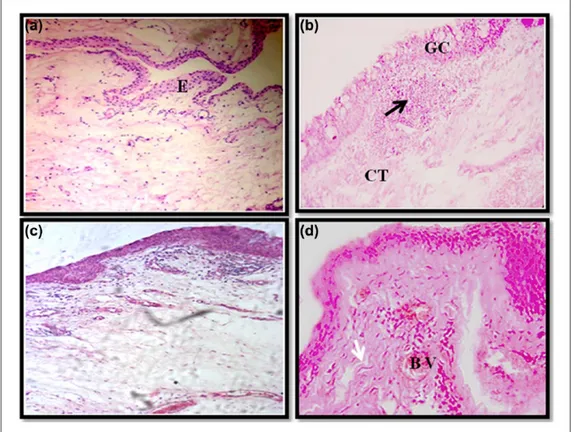 Figure 1.  Histopathology of normal conjunctiva tissues (control) (a) and pterygium (b, c and d) biopsies