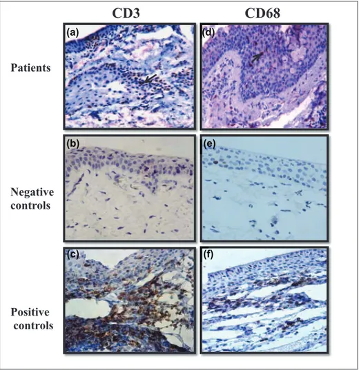 Figure 2.  Immunohistochemical staining for CD3 (a, b and c) and CD68 (d, e and f), in pterygium, normal conjunctiva (negative 