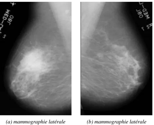 Figure II.6: Une asymétrie de densité observée seulement sur la mammographie gauche.