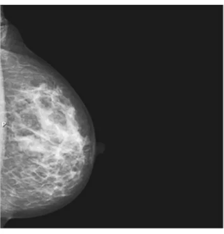 Figure 1.2.  Tissu mammaire normal tel qu'il apparaît sur une mammographie. [Siemens  2017] 