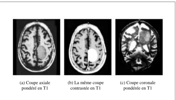 Figure 1.10 : Méningiome [MEZ11]. 