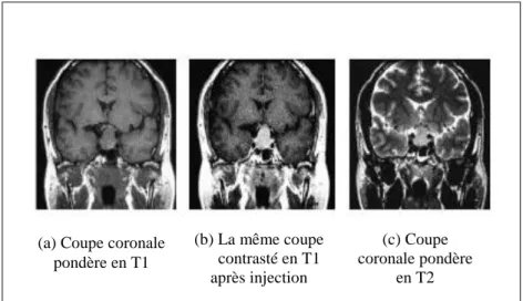 Figure 1.11 : L’Adénome hypophysaire [MEZ11]. 
