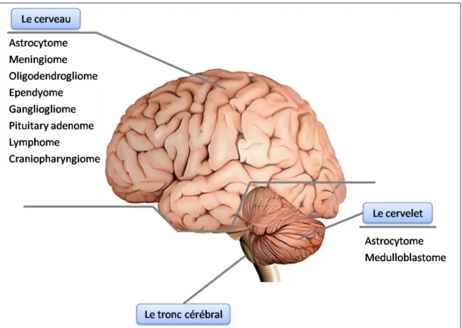 Figure 1.12 : Classification des tumeurs en fonctions de leur emplacement [KLE00]. 