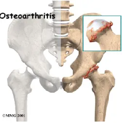 Figure 1: Hanche atteinte par l’ostéoarthrite. Figure tirée de  www.parkwayphysiotherapy.ca 