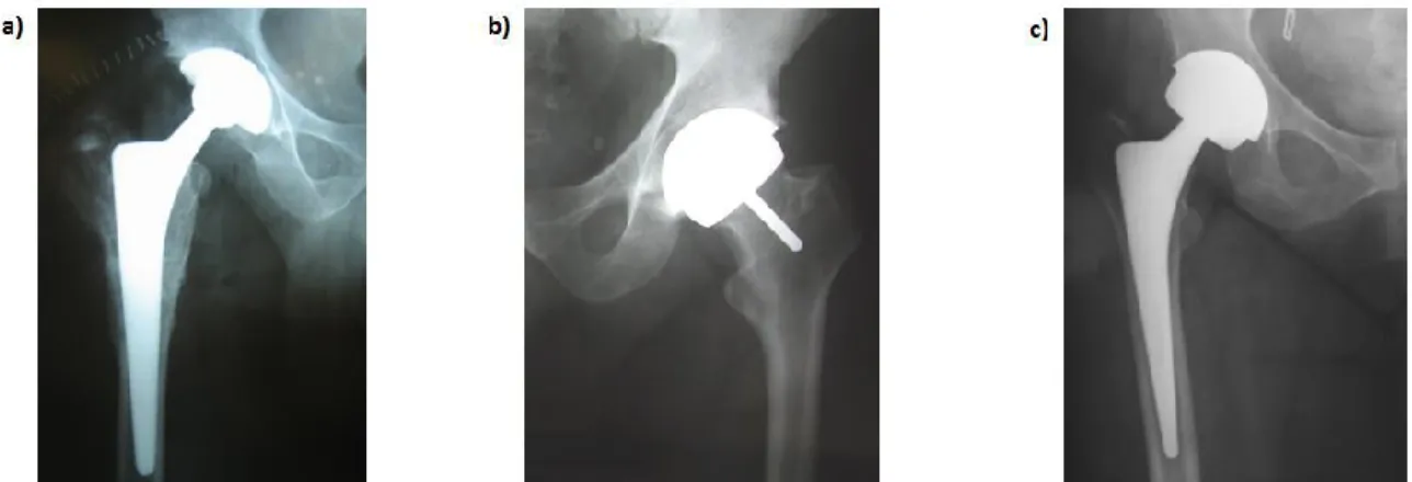 Figure  3:  Les  différents  types  de  prothèse  de  hanche,  a)  prothèse  totale  de  hanche  (PTH),  b)  prothèse de resurfaçage (RES) et c) prothèse totale de hanche avec grande tête fémorale  (PTH-GT).