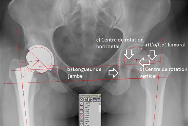 Figure 4: Mesures radiographiques a) Offset fémoral b) Inégalité de la longueur de jambe c) Centre  de rotation horizontal d) Centre de rotation vertical