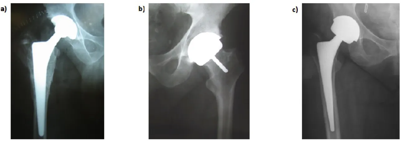 Figure  5:  Prostheses  evaluation  in  this  study  a)  Total  hip  arthroplasty  (THA)  b)  Hip  resurfacing  arthroplasty (HR) c) Large diameter femoral head total hip arthroplasty (LDH-THA)