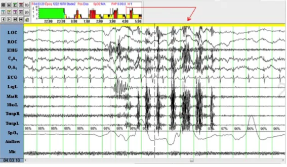 Figure 1.1 Hypnogram and polysomnographic tracing showing an episode of rhythmic  masticatory muscle activity (RMMA) during sleep
