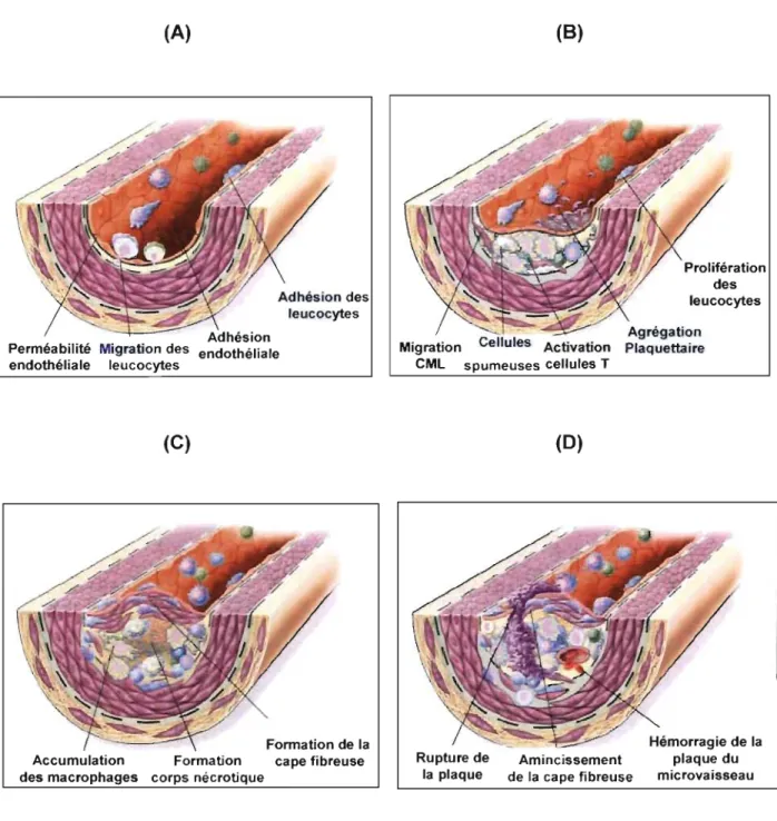 Figure  2.  Évolution  de  la  plaque  athérosclérotique.  (A)  Première  étape  de  la  formation  de  l'athérosclérose:  adhésion  et  migration  des  leucocytes