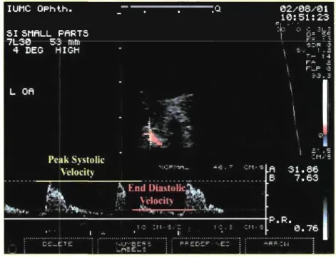 Figure  1.8:  Color Doppler  imagin g  showing  peak  systolic  and  end-diastolic  velocltles  in  the  ophthalmic  artery  (courtes 