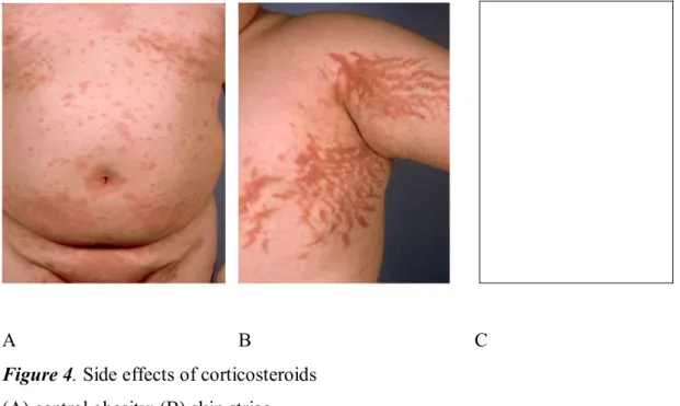 Figure 4. Side effects of corticosteroids  (A) central obesity; (B) skin striae 