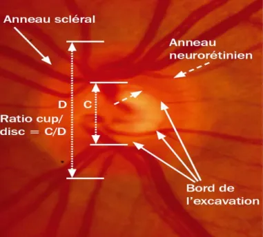 Figure 1.5 :  La mesure de la profondeur de l'excavation et la perte des fibres de  l’anneau neurorétinien effectuée à l’aide du rapport entre l’excavation (cup) et la papille  optique (disc)