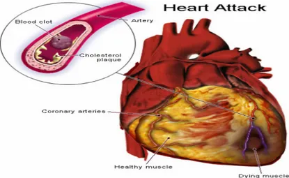 Fig. 1 - Myocardial infarction (http://www.straightfromthedoc.com/50226711/flickr_39524  1000.jpg)