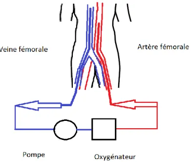 Figure 1. Schéma simplifié d’un circuit de R-CEC. Le sang est aspiré via la canule fémorale, située  dans la veine fémorale, puis est oxygéné dans un circuit externe au corps, puis est repompé par  la canule artérielle fémorale