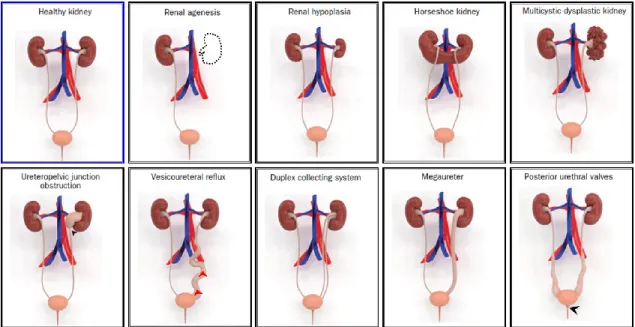 Figure  4.  Illustrative  3D  models  of  congenital  abnormalities  of  the  kidney  and  urinary  tract (CAKUT) that were created using the modeling tools ZBrush (Pixologic, Inc.) and  3ds Max (Autodesk, Inc.), to illustrate the phenotypic spectrum of CA