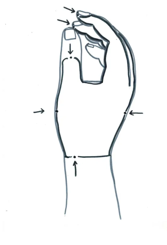Figure 1 : Allodynography on the right hand performed on April 1 st , 2014, showing the skin  area innervated by the superficial branch of radial nerve on which static mechanical allodynia  (SMA) was found