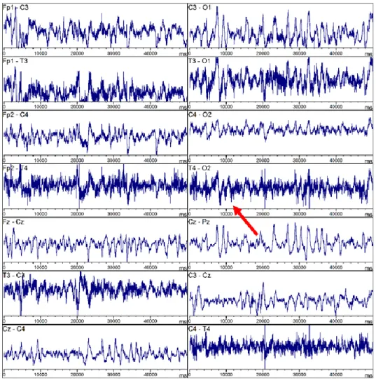 Figure 6. –   Exemple de signaux perturbés par des artéfacts d’EMG (montage bipolaire), récupérés 
