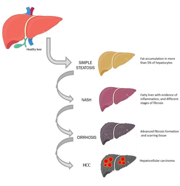 Figure 1.-  The spectrum of liver pathologies in non-alcoholic fatty liver disease. 