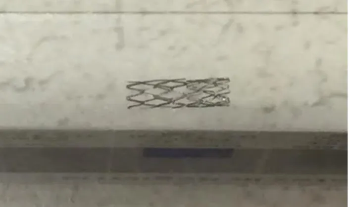Figure  7.  Plasticised  bare-metal  cobalt-  chromium stent. With permission from 