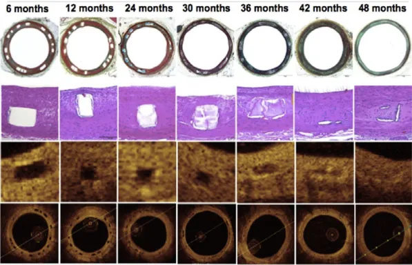 Figure  12.  Histological  and  optical  coherence  tomography  (OCT)  evolution  in  resorption  of  ABSORB BRS in a porcine coronary arteries model
