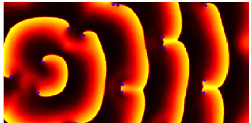 Fig. 1.1. Exemple de fibrillation. SP en bleu
