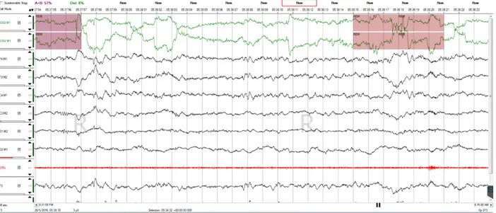 Figure 1.5  Tracé EEG d’une jeune participante sans trouble de sommeil lors du stade de sommeil  paradoxal sur une époque de 30 secondes
