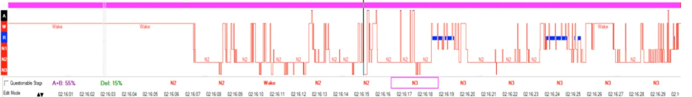 Figure 1.7  Hypnogramme  d’une  participante  aînée  avec  un  trouble  d’insomnie  et  avec  une  consommation chronique de BZD