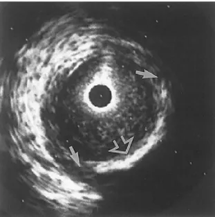 Figure 2.6 An IVUS image of an internal carotid artery acquired by a 30 MHz transducer