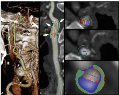 Figure  2.9  Plaque  component  analysis  of  a  75-year-old  man  with  a  transient  ischemic  attack using CT image reconstruction software