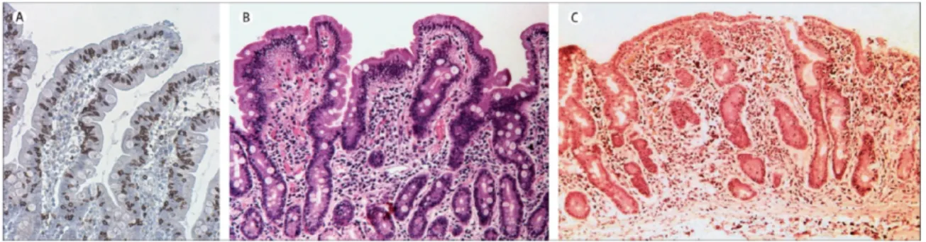 Figure 6: évolution représentative de l’atteinte histologique dans la MC. 